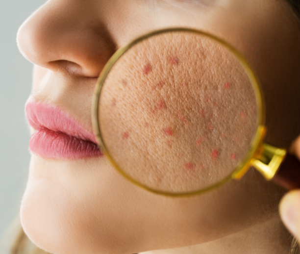 Eczema Treatment Sharjah