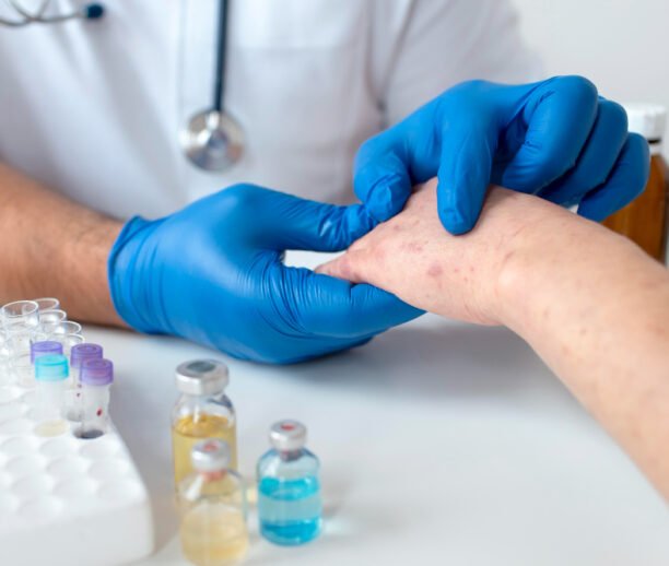 Eczema Treatment Ajman