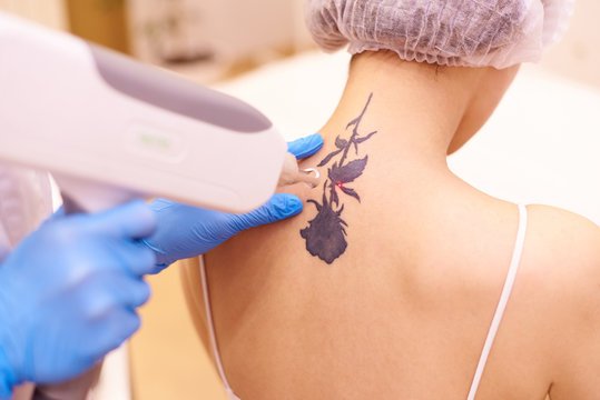 Laser Tattoo Removal Clinic UAE