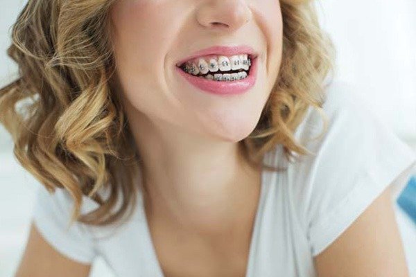 Braces Specialist Ajman