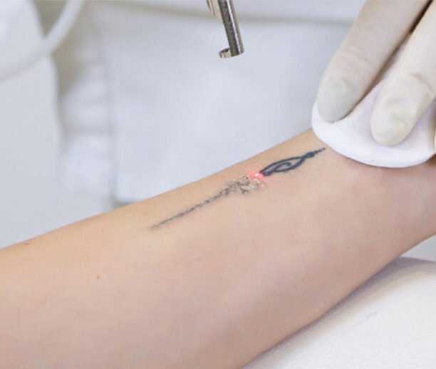 Laser Tattoo Removal Clinic Ajman