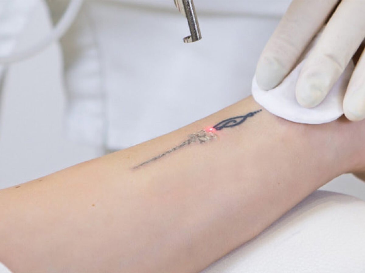 Laser Tattoo Removal Clinic Ajman
