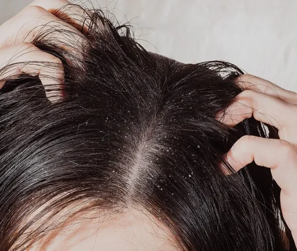 Dandruff treatment Ajman