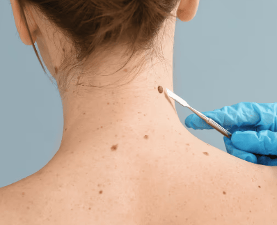 Skin tag removal Ajman
