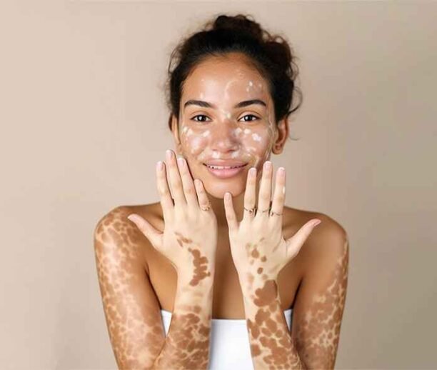 Vitiligo treatment Ajman