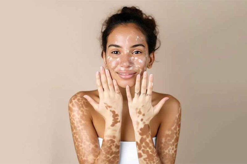 Vitiligo Treatment Ajman