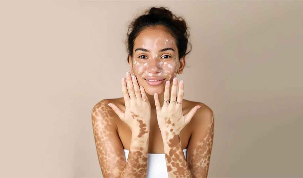 Vitiligo treatment Ajman