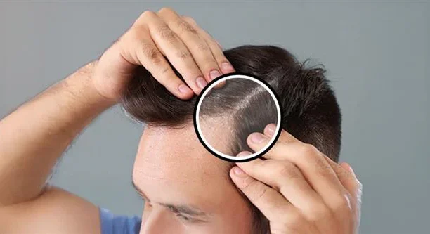 Dandruff treatment Ajman
