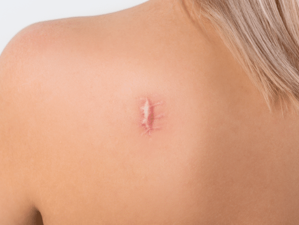 Keloid treatment Ajman