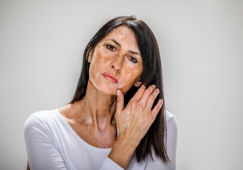 Vitiligo treatment Ajman