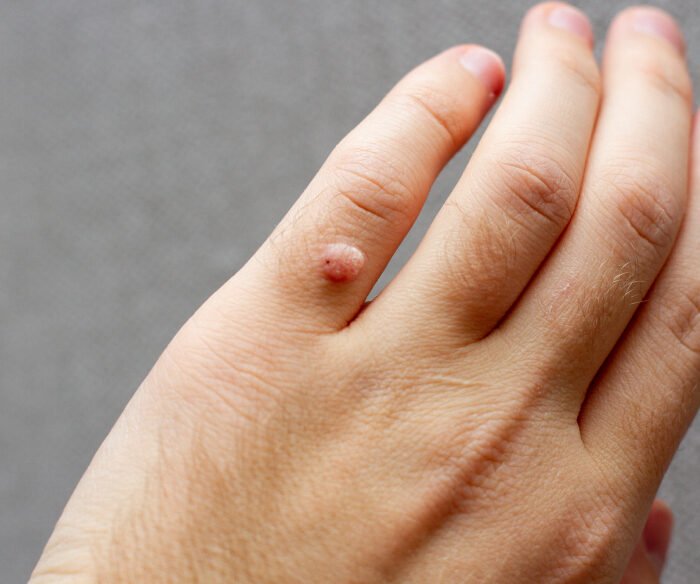 Wart removal Ajman
