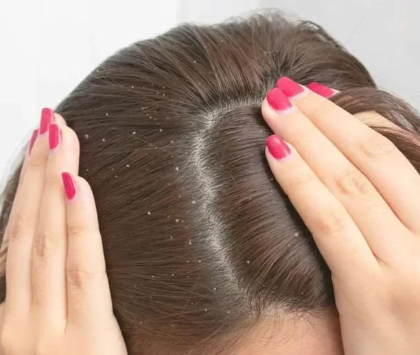 Dandruff treatment Ajman