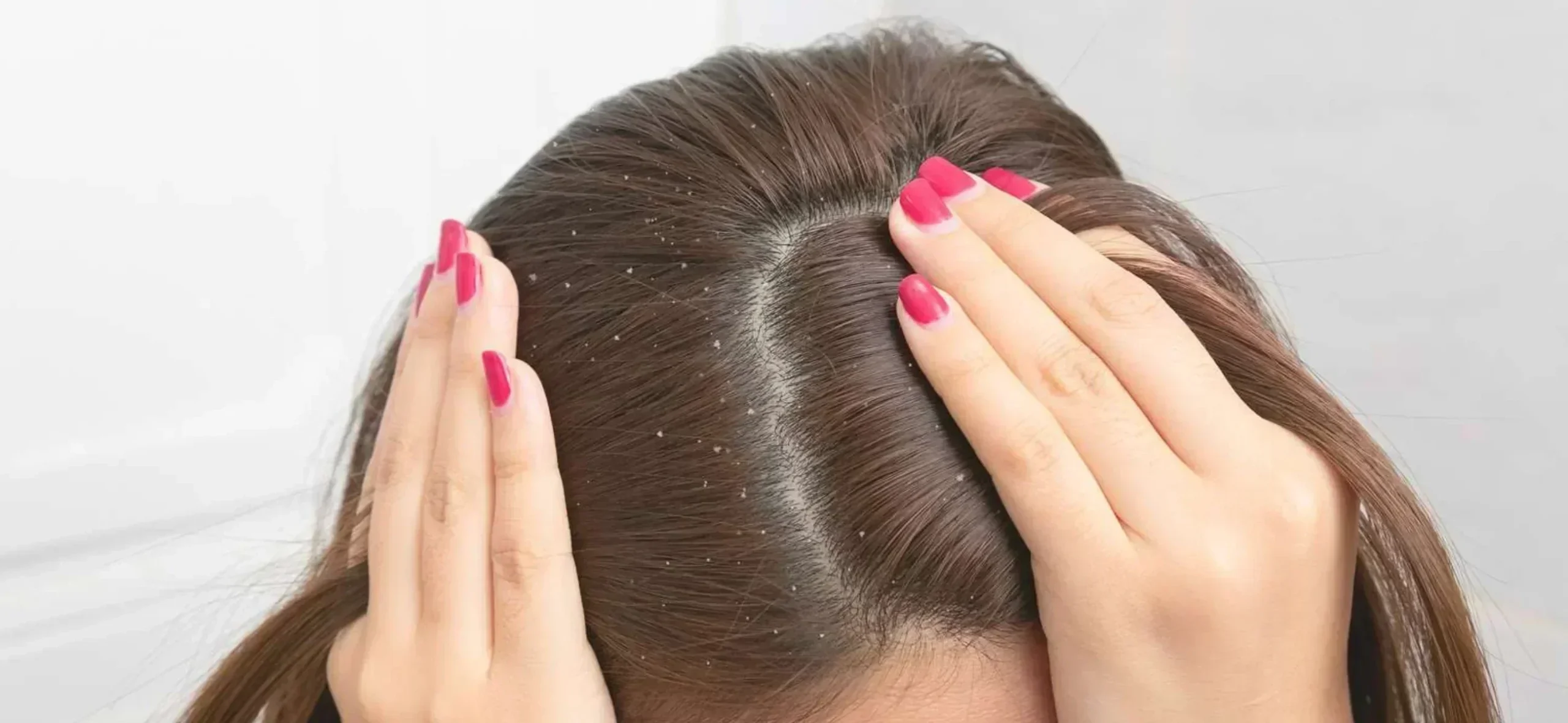 Dandruff treatment Ajman