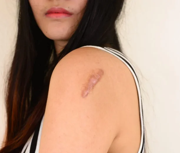 Keloid treatment Ajman