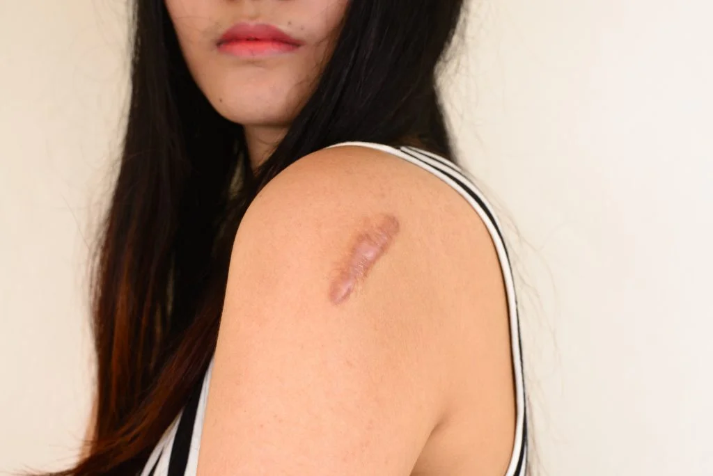Keloid treatment Ajman