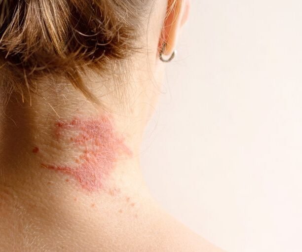 Skin infection treatment Ajman