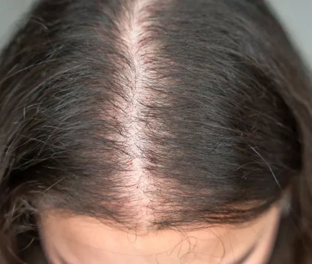 Hair thinning treatment Ajman