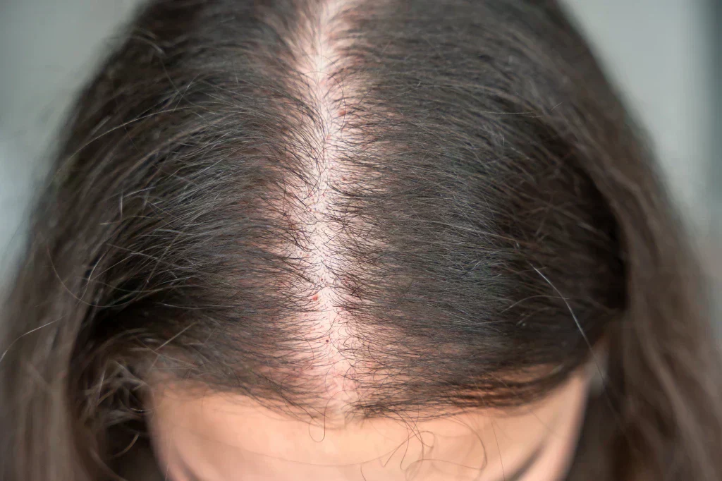 Hair thinning treatment Ajman