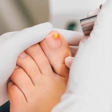 Nail infection treatment Ajman