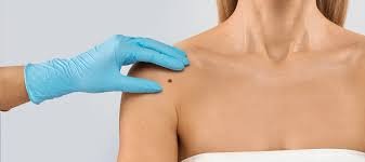 Skin tag removal Ajman