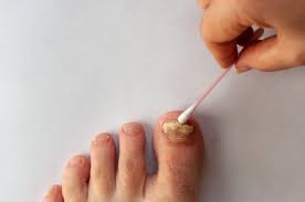 Nail infection treatment Ajman