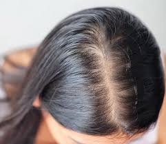 Hair fall treatment Ajman