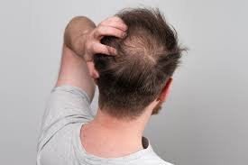 Hair thinning treatment Ajman