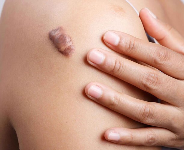 Keloid treatment Ajman