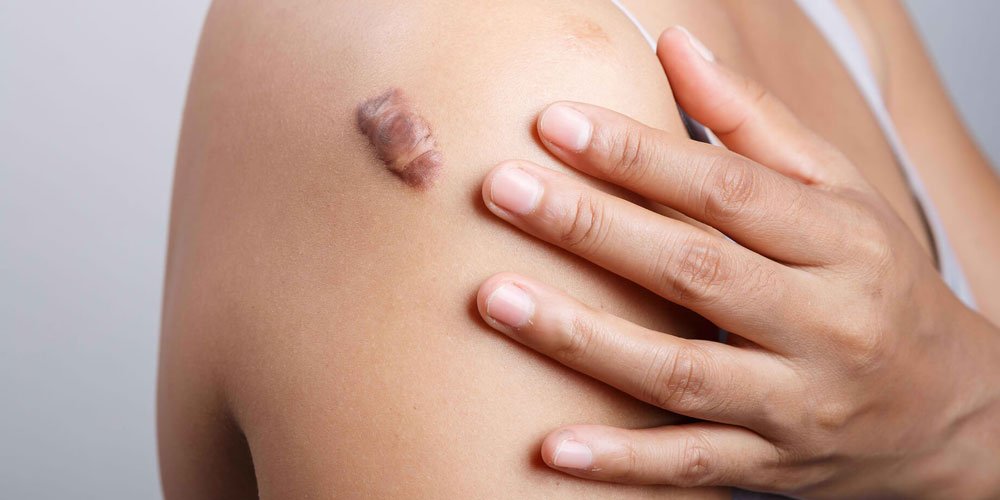 Keloid treatment Ajman