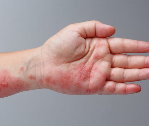 Chickenpox scar removal Ajman