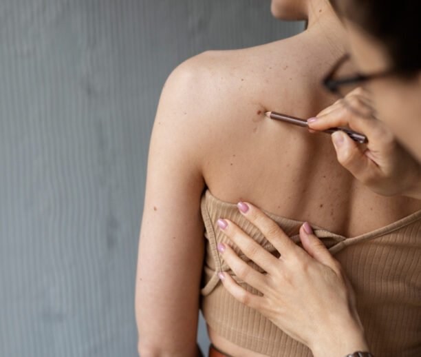 Chickenpox scar removal Ajman