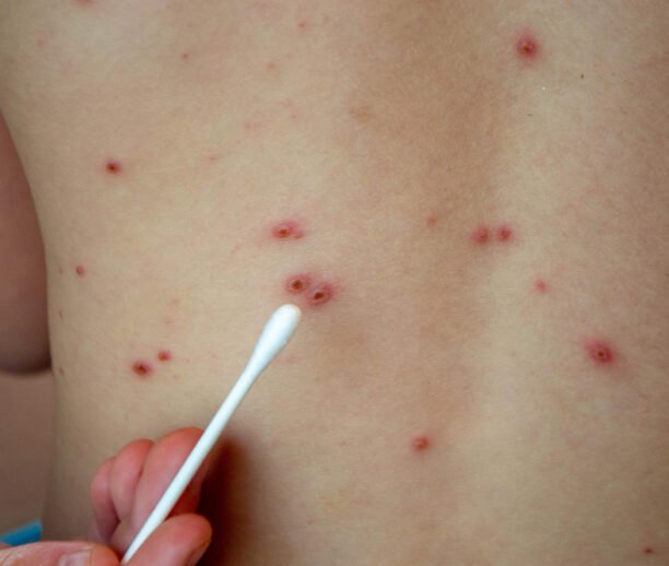 Chickenpox scar removal Ajman