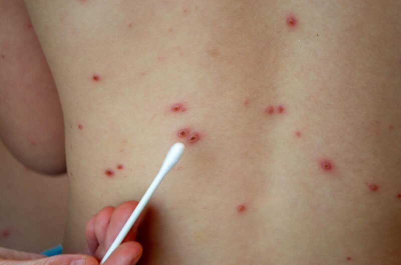 Chickenpox Scar Removal Ajman