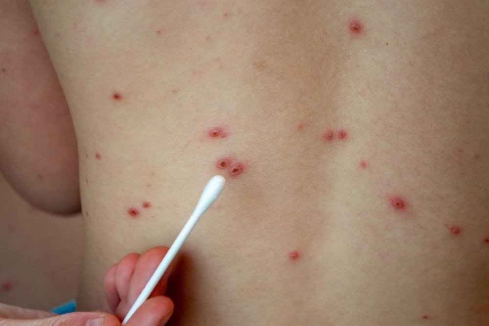 Chickenpox scar removal Ajman