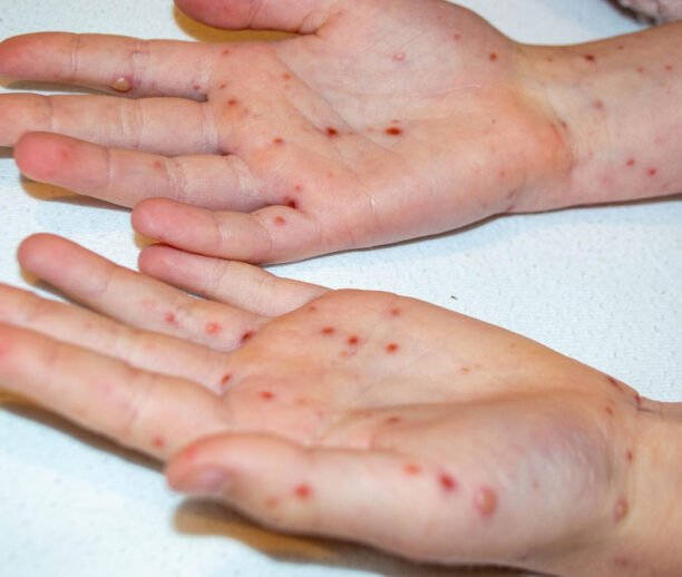 Chickenpox scar removal Ajman