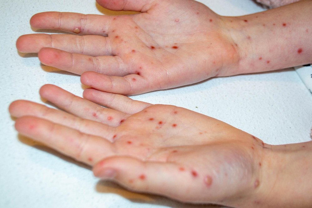 Chickenpox scar removal Ajman